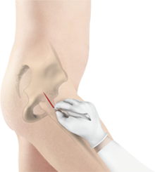Minimally Invasive Hip Replacement