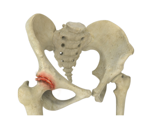 Hip Osteoarthritis